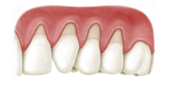 Tụt nướu có thể xảy ra ở một vài răng hoặc toàn bộ hàm răng (Nguồn: St)